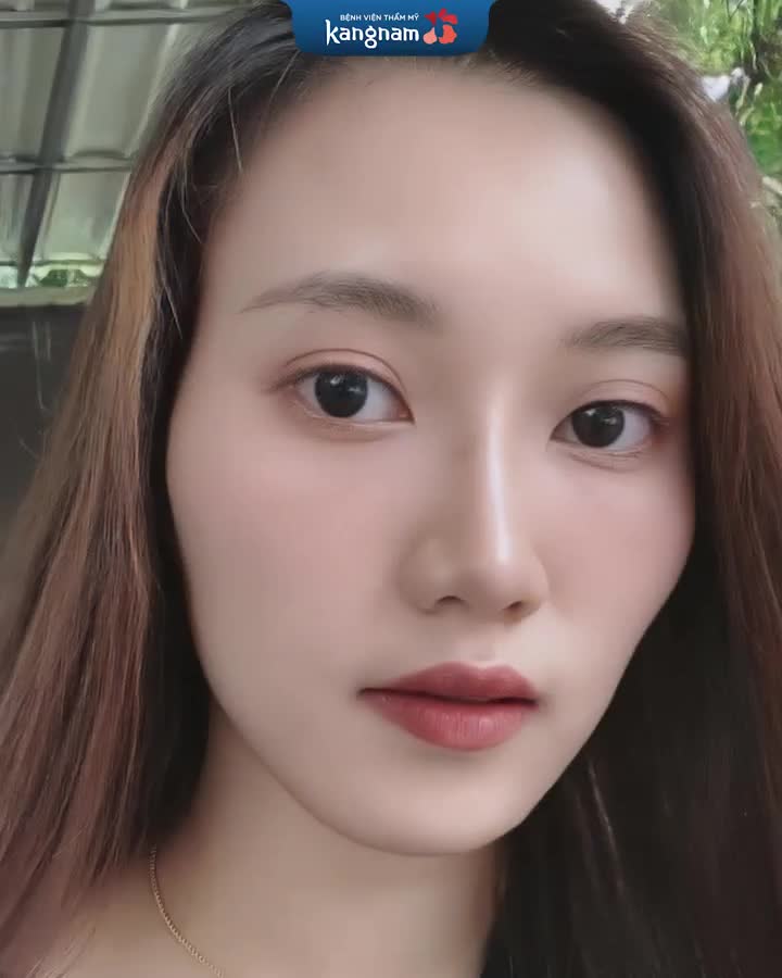 Khách hàng cấy mỡ sau 1 tháng gửi feedback cưng xỉu